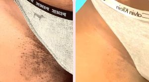 سفید کردن واژن در آمل