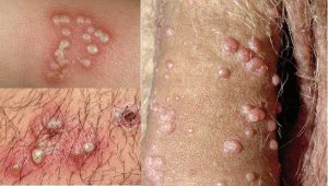 درمان زگیل تناسلی در آمل