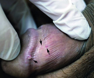 درمان زگیل تناسلی در آمل