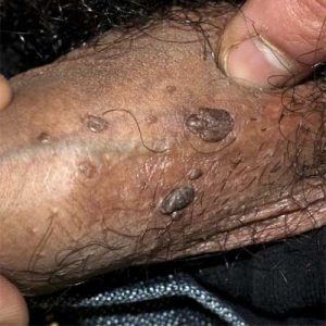 درمان زگیل تناسلی در آمل