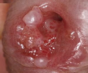 درمان زگیل تناسلی در آمل