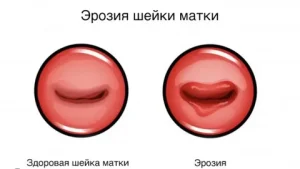 درمان زخم دهانه رحم در آمل