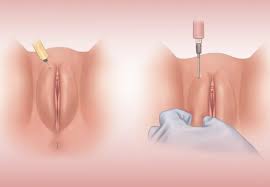 ژل لابیا در آمل