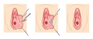 لابیاپلاستی با لیزر در آمل 