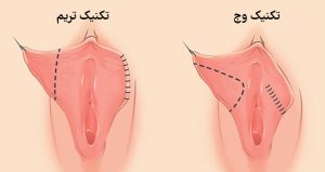 لابیاپلاستی با لیزر در آمل 
