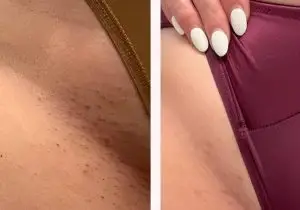 سفید کردن واژن در آمل