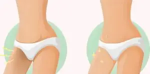 سفید کردن واژن در آمل