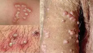 درمان زگیل تناسلی در آمل