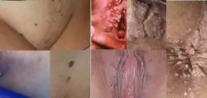 درمان زگیل تناسلی در آمل