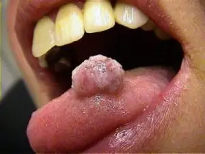 درمان زگیل دهانی در آمل