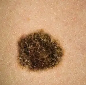 درمان زگیل تناسلی در آمل