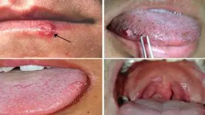 درمان زگیل تناسلی در آمل