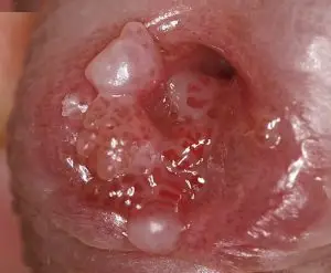 درمان زگیل تناسلی در آمل