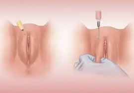 ژل لابیا در آمل