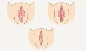 لابیاپلاستی با لیزر در آمل