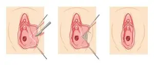 لابیاپلاستی با لیزر در آمل