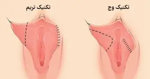 لابیاپلاستی با لیزر در آمل