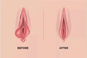 لابیاپلاستی با لیزر در آمل