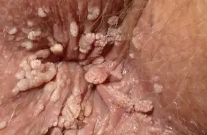 درمان زگیل تناسلی در آمل با لیز